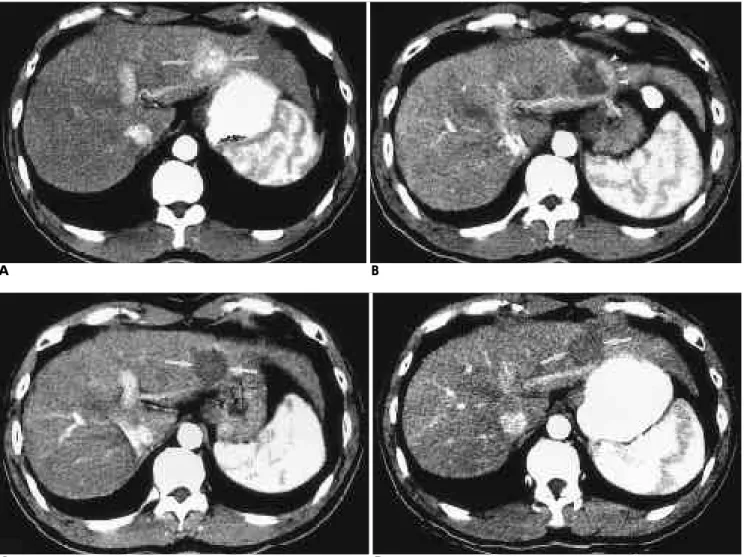 Fig. 2. HCC before and after RF ablation in 57-year-old man. 