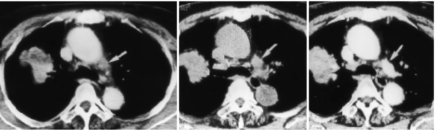 Table 4. Factors Improving Positive Predictive Value of Thin-sec- Thin-sec-tion Spiral CT in the EvaluaThin-sec-tion of Mediastinal Lymph Node  Me-t a s Me-t a s i s