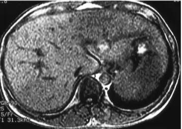 Fig. 1. Location of a voxel with 8cm 3 (2 cm×2 cm×2 cm) at the human liver.