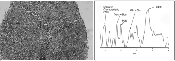 Fig. 7. A. Histopathologic finding of the human liver with chronic hepatitis categorized into Ludwig’ s classification IV (Masson trichrome staining, ×1 0 0 ) .