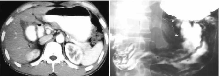 Fig. 6. Ectopic pancreatic rest of stomach in a 43-year-old man.