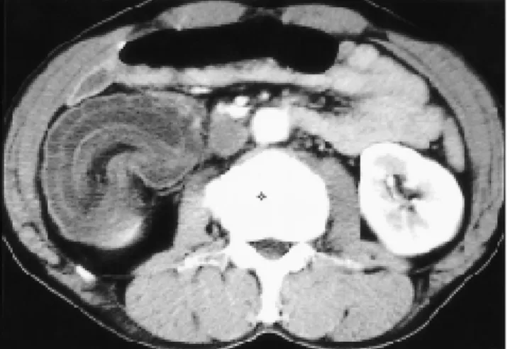 Fig. 18. N o n - H o d g k i n’s lymphoma of cecum with intussuscep- intussuscep-tion in a 57-year-old man.