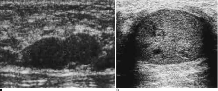 Fig. 2. Solid typed benign and malignant papillary lesions.