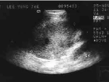 Fig. 4. Photograph of resected specimen shows a well-defined mass measuring 13cm×8 c m×6cm and 270 gm