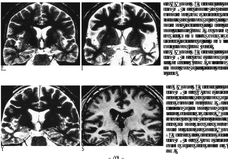 Fig. 2. Coronal T2-weighted fast spin- spin-echo MR image through the anterior hippocampus shows increased signal intensity and atrophy of the left  hip-pocampus, indicative left mesial  tem-poral sclerosis (arrow)