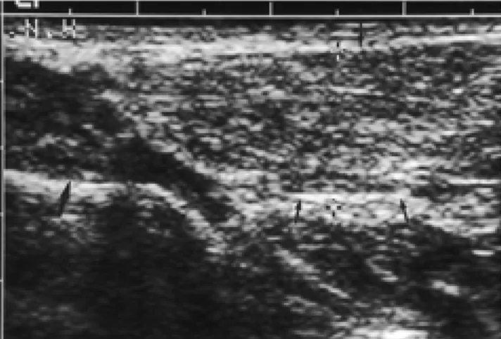 Fig. 2. Transverse ultrasonogram shows isoechogenic lipoma (arrows) that is well-defined and elliptical in shape
