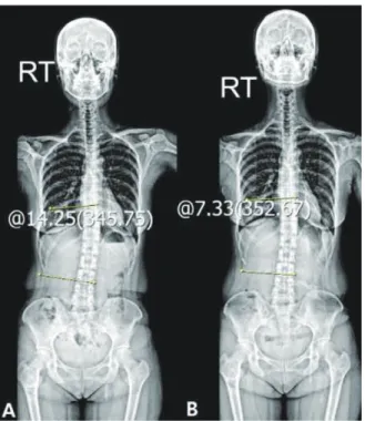 Fig. 1. Whole spine standing x-ray(Case 1). Fig. 2. Sagittal and axial view. Level L5/S1 (Case 1).