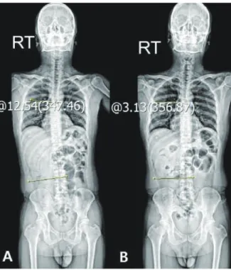 Fig. 3. Whole spine standing x-ray(Case 2). Fig. 4. Sagittal and axial view. Level L5/S1 (Case 2).