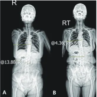 Fig. 9. Whole spine standing x-ray(Case 5).  Fig. 10. Sagittal and axial view. Level L3/4(Case 5).