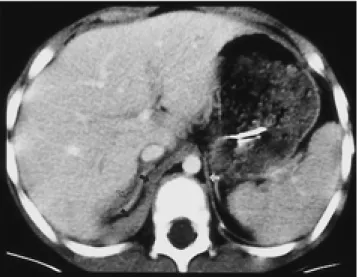 Fig. 4. A 5-year-old boy with delayed diaphragmatic hernia. 