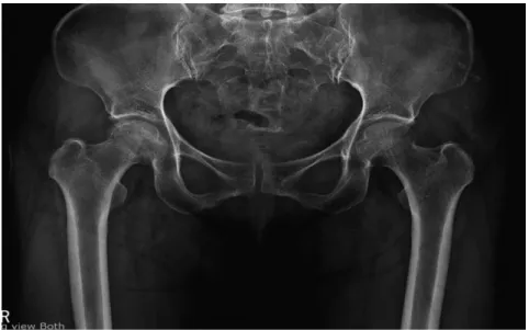 Fig. 1. X-ray hip(2019.4.8.).