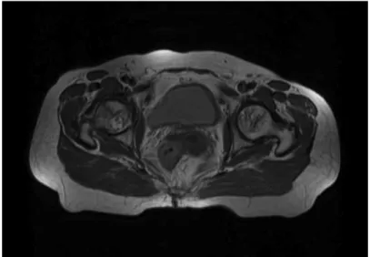 Fig. 3. MRI hip joint - axial view(2019.04.09.).