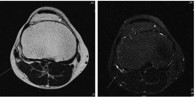 Fig. 2.  Rt. knee MRI axial view (T2 Image &amp; T2 FAT FRFSE Image).