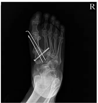 Fig. 3. Rt. foot X-ray after surgery(2018.05.15.).