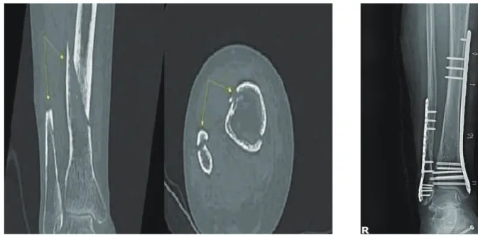 Fig. 5. Rt. fibula &amp; tibia X-ray  (2018.10.29.).