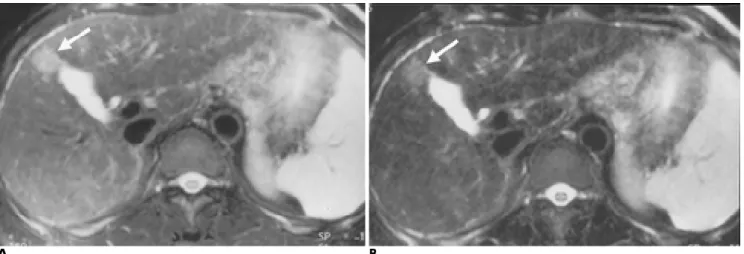 Fig. 1. Dual-echo T2-weighted TSE images of HCC. 