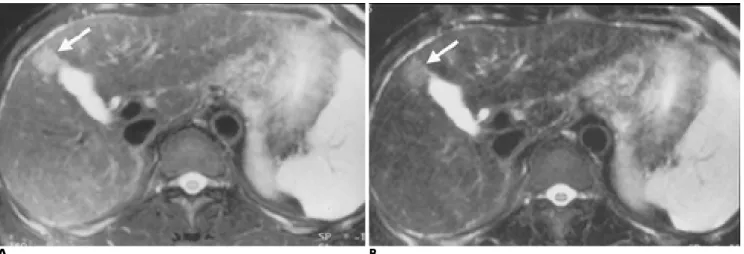 Fig. 1. Dual-echo T2-weighted TSE images of HCC. 