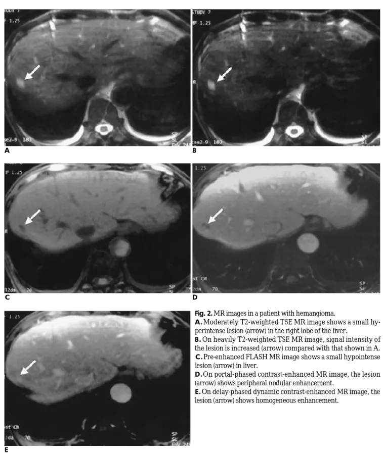 Fig. 2. MR images in a patient with hemangioma.