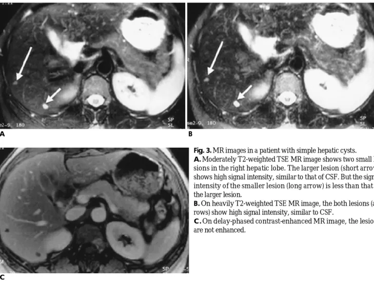Fig. 3. MR images in a patient with simple hepatic cysts.