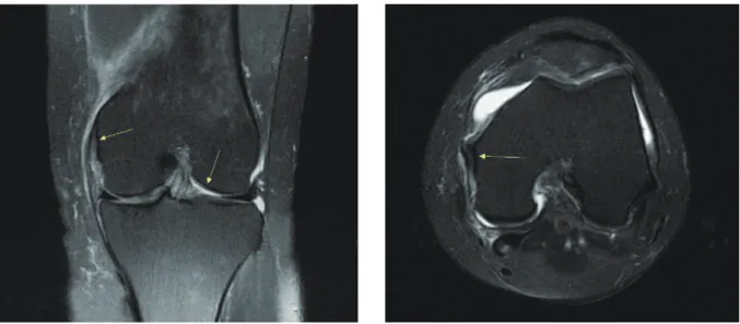 Fig. 1. MRI of left knee T2 coronal, axial view.