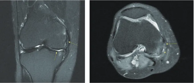 Fig. 2. MRI of right knee T2 coronal, axial view.