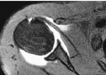 Fig. 3. Anterior capsular insertion type III in a 22-year-old man.