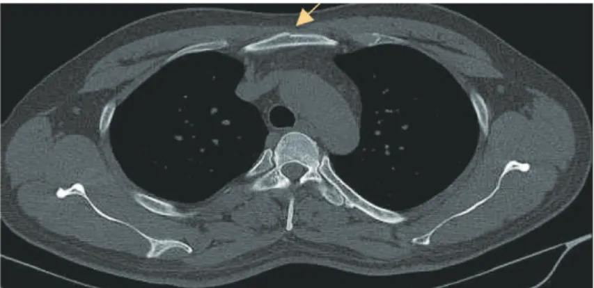 Fig. 3. Patient 3 sternum fracture.