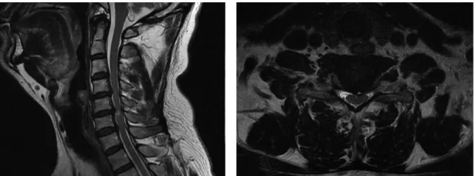 Fig. 1. T2 weighted sagittal and axial view before operation.