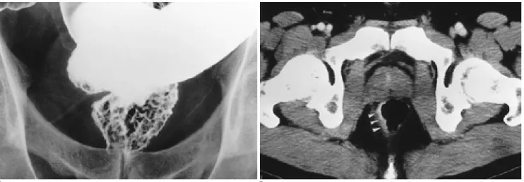 Fig. 1. A 32-year-old man presented with blood tinged stool for ten months.