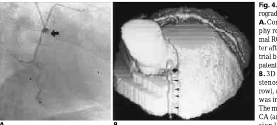 Fig. 4. Total occlusion with distal ret- ret-rograde flow via collaterals.