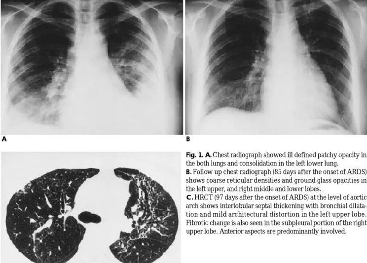 Fig. 1. A. Chest radiograph showed ill defined patchy opacity in the both lungs and consolidation in the left lower lung.