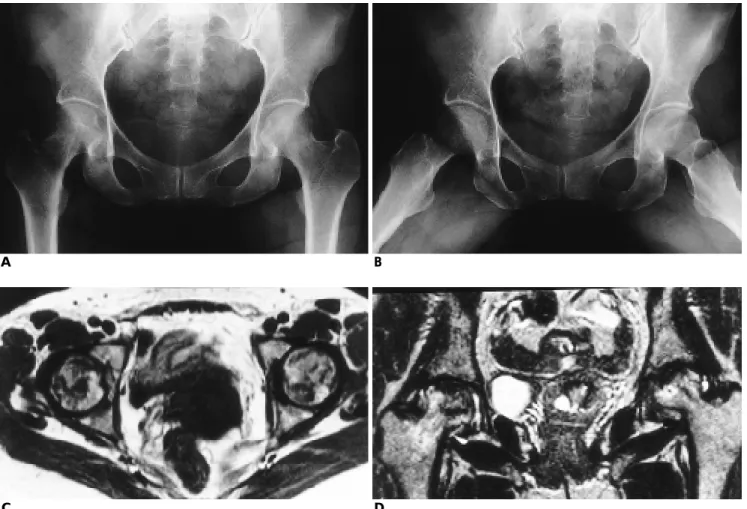 Fig. 1.A 42-year-old woman with both hip pain.