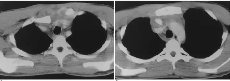 Fig. 2. A,B. CT scan demonstrates posterior dislocation of right sternoclavicular joint and adjacent mediastinal high density of soft tissue swelling, indicating hematoma, compressing proximal SVC and both innominate veins but well patent.