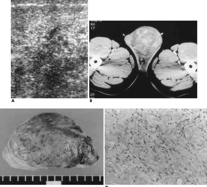 Fig. 1. A. Ultrasonography of the scrotum shows a huge heterogeneous mixed echoic mass.