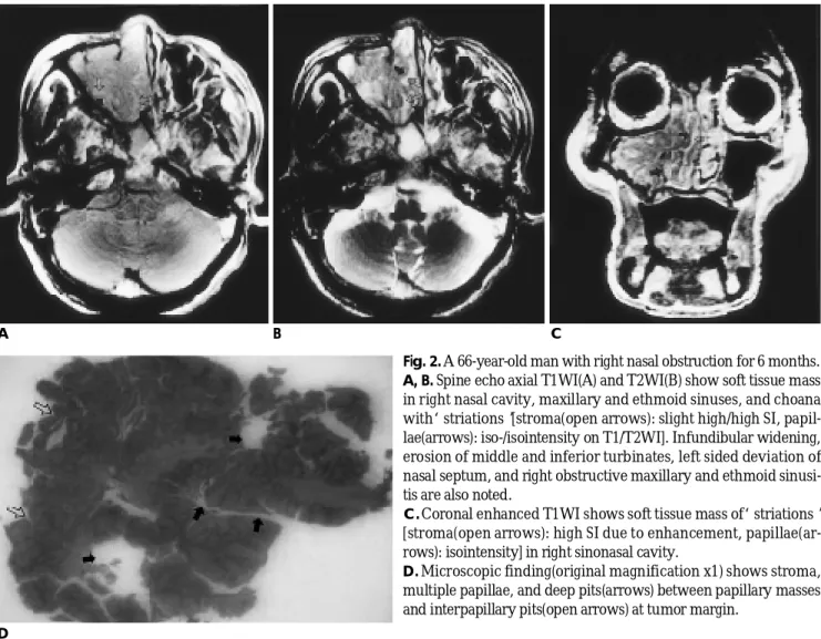 Fig. 2.A 66-year-old man with right nasal obstruction for 6 months.