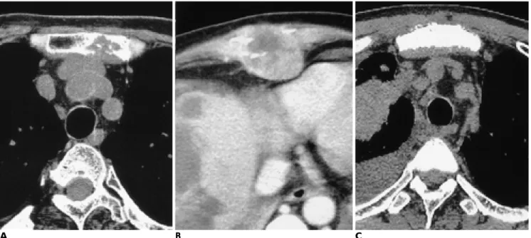 Fig. 2. Metastatic sternal tumors.