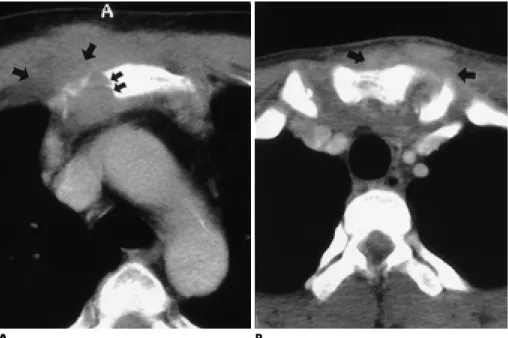 Fig. 3. Non-neoplastic masses of the s t e r n u m .