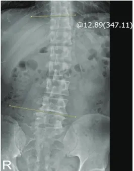 Fig. 1. L-SPINE X-ray AP view.