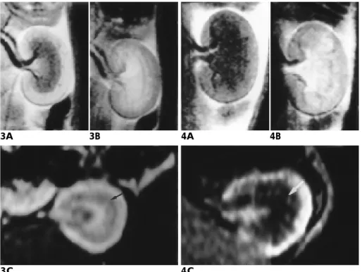 Fig. 3. Day one Acute Tubular Necrosis.