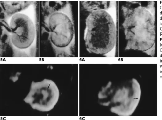 Fig. 6. Day four Crescentic Glomeru- Glomeru-l o n e p h r i t i s .