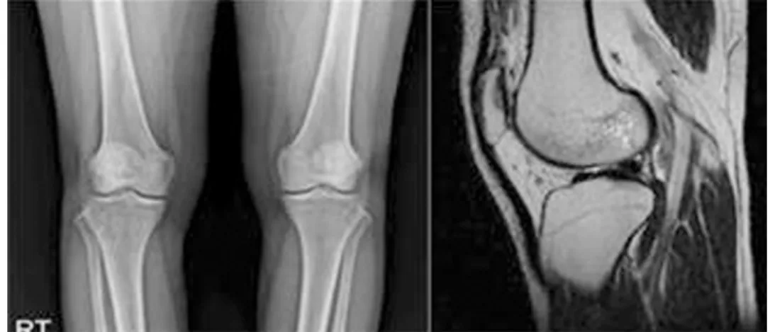 Fig. 1. Both Knee X-ray, Rt. Knee MRI Case 1.