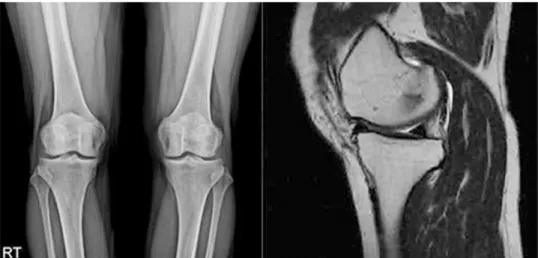 Fig. 2. Both Knee X-ray, Lt. Knee MRI Case 2.