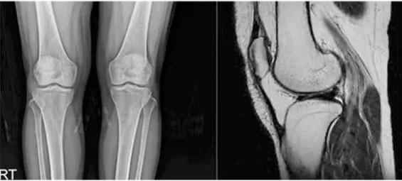 Fig. 3. Both Knee X-ray, Rt. Knee MRI Case 3.