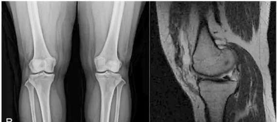 Fig. 4. Both Knee X-ray, Lt. Knee MRI Case 4.