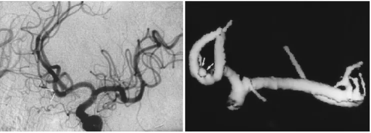 Fig. 4. Advantage of CT angiogram in detection of aneurysm less than 3 mm in diameter.