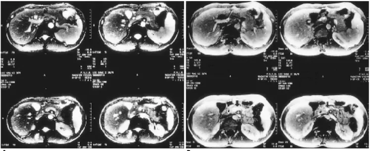 Fig. 1. A 36-year-old male patient with hepatocellular carcinoma at segment 7(not shown) without PV thrombosis