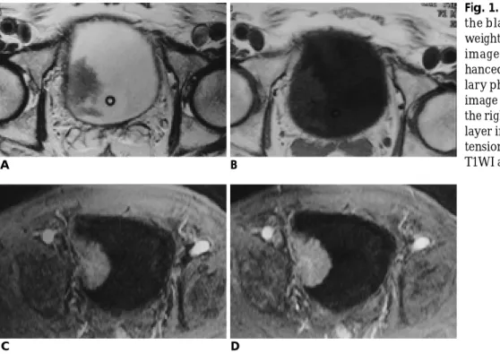 Fig. 1. Transitional cell carcinoma of the bladder, stage pTIIIa. Axial  T2-weighted image (A), axial T1-T2-weighted image (B), arterial phase of  Gd-en-hanced dynamic image (C), and  capil-lary phase of Gd-enhanced dynamic image (D) show a protruding mass