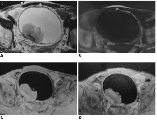 Table 2. Correlation of T-staging on Gd-enhanced Dynamic MR Imaging with Pathologic Staging
