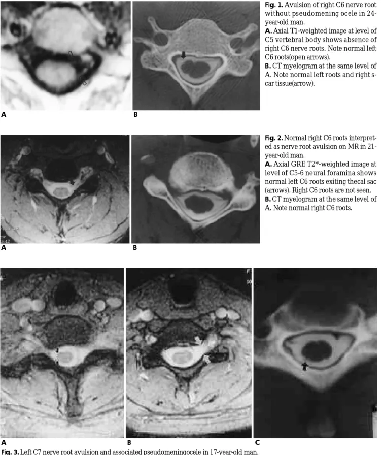 Fig. 1. Avulsion of right C6 nerve root without pseudomening ocele in  24-year-old man.
