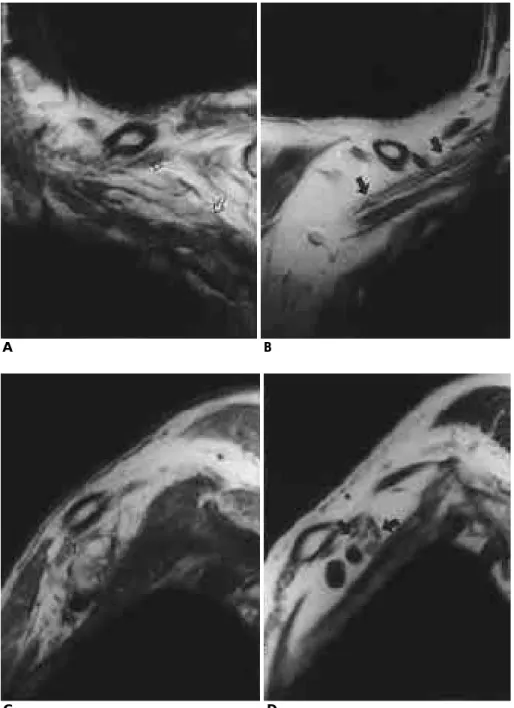 Fig. 4. Surgically proven normal left postganglionic brachial plexus  inter-preted as diffuse brachial plexus  in-j u r y .